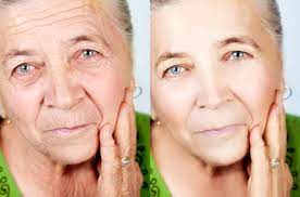Improve The Natural Collagen Production With Facelift Botox